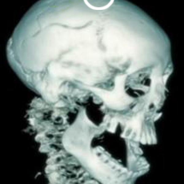 Imatge tomogràfica del crani del rei amb indicació del punt on s’identificaven les evidències del meningioma (Autor: Hospital Joan XXIII de Tarragona; tractament de la imatge: Grup de Recerca en Osteobiografia. Universitat Autònoma de Barcelona)